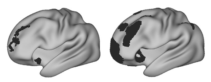 A brain network linked to attention is larger in people with depression